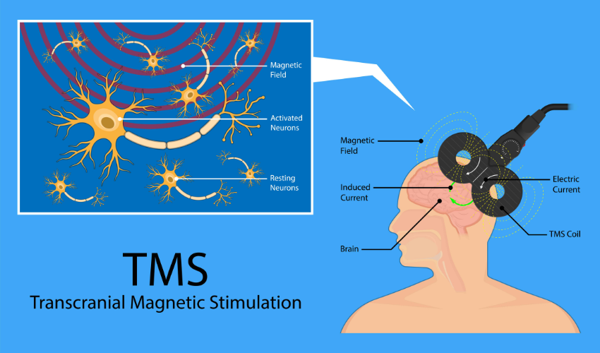 Transcranial Magnetic Stimulation